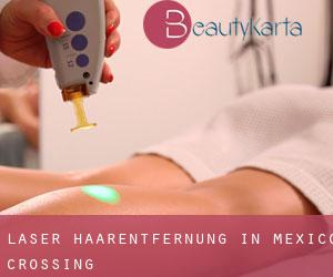 Laser-Haarentfernung in Mexico Crossing